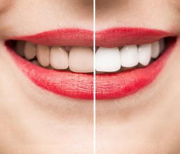 Virginia Biological Dentistry recommends best methods for teeth whitening