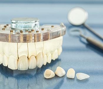 A guide to dental crowns and bridges in Charlottesville