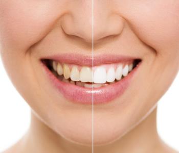 Home teeth whitening in Glen Allen
