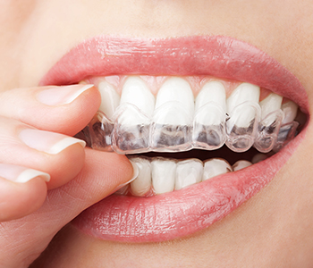 Dr oliviya heart, Virginia Biological Dentistry Proving Invisalign Treatment