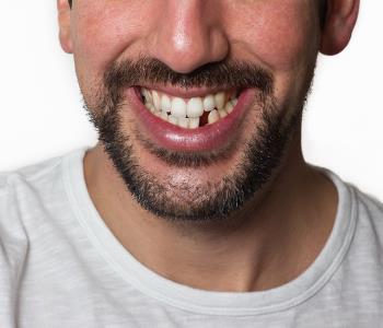 A Virginia Biological Dentistry can replace a missing tooth to restore the function and beauty of your smile