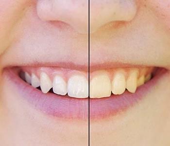 Fredericksburg, VA, residents ask, “Do teeth whiteners really work?”
