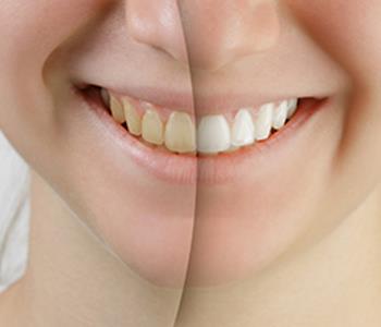Teeth whitening treatment saves you the cost of discoloration when you see your Glen Allen Dentist