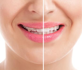 What methods of teeth whitening are available for Charlottesville area patients?