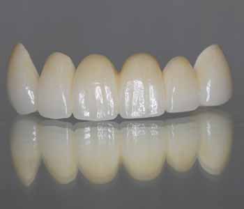 Healthy-savvy patients in Glen Allen, VA choose zirconia implants treatment
