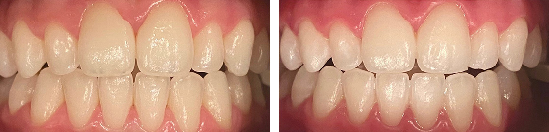 Teeth Whitening Before and After Results at Virginia Biological Dentistry - Case 1