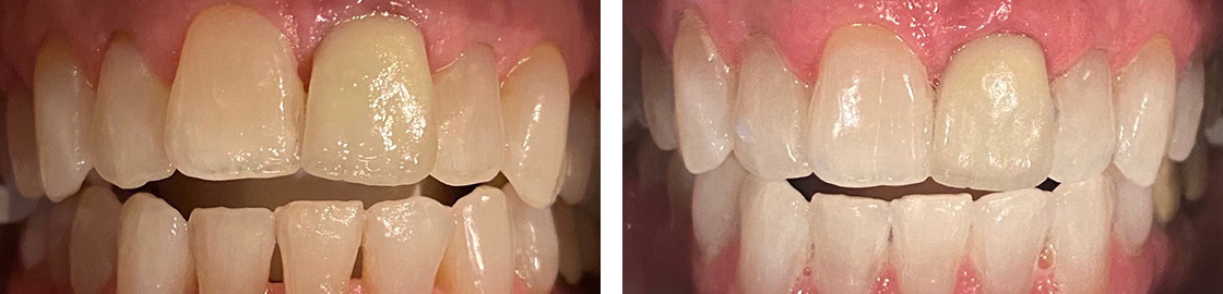 Teeth Whitening Before and After Results at Virginia Biological Dentistry - Case 2