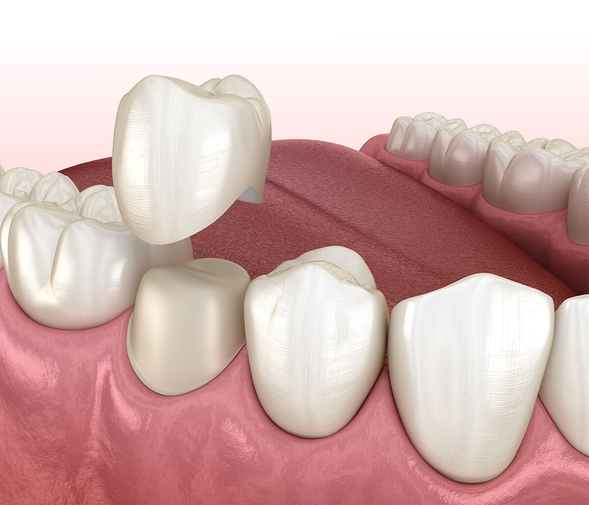 The Technology Which Makes Convenient CEREC Same-Day Ceramic Crowns Possible