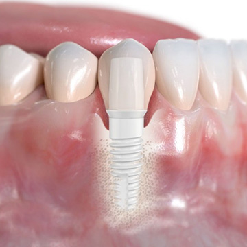 Ceramic Dental Implants Glen Allen VA