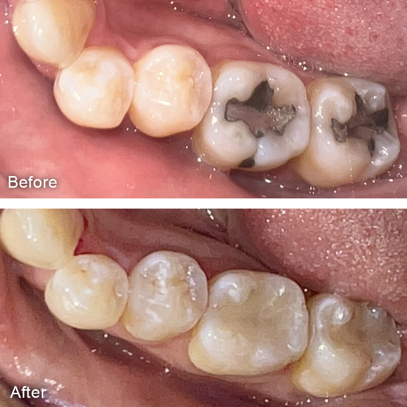 Amalgam Replacement Before and After Treatment Image 1