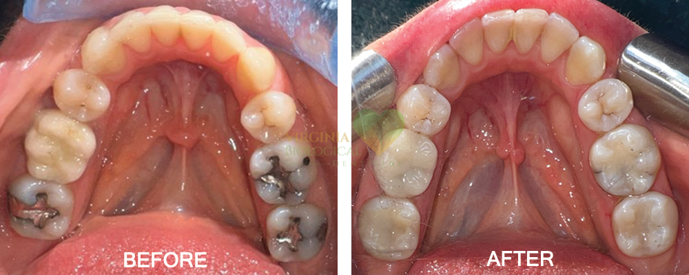 Safe Mercury Removal - Virginia Biological Dentistry, VA