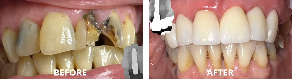 Ceramic implants and Ceramic Crown Restorations Before After Results