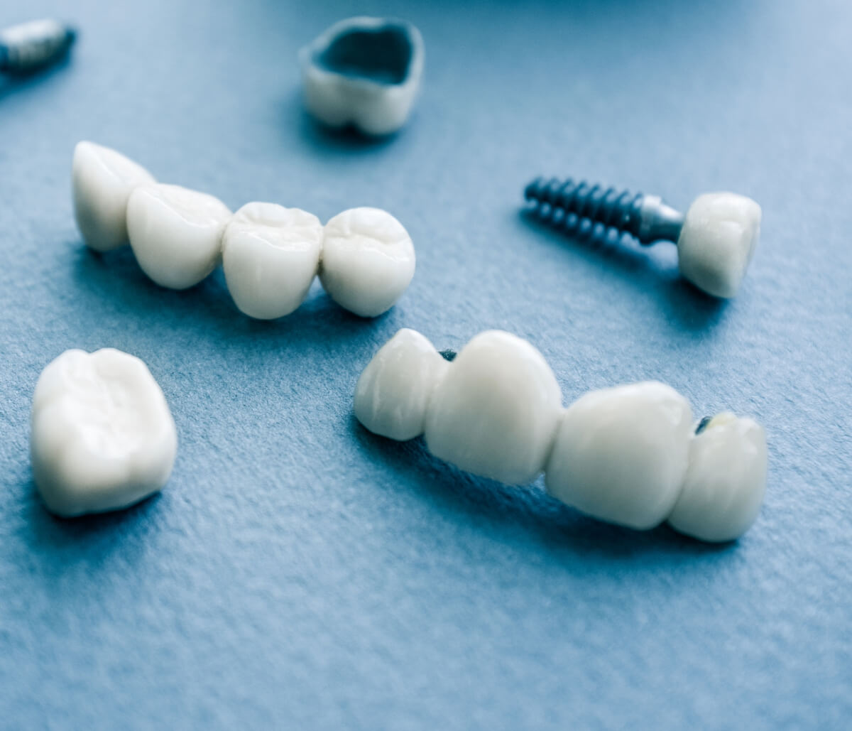 Do I need a dental crown for a cracked tooth?