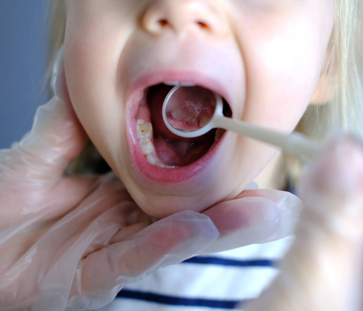 What is a frenectomy? Learn more about this tongue tie treatment