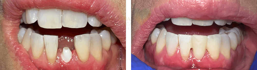 Zirconia Implants - Before After Results, 1 at Virginia Biological Dentistry, VA