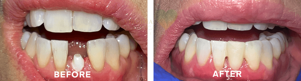 Zirconia Implants - Before After Results, 1 at Virginia Biological Dentistry, VA