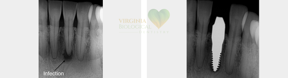 Zirconia Implants - Before After Results, 2 at Virginia Biological Dentistry, VA