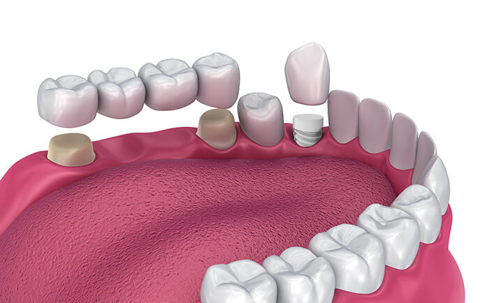 All-Ceramic Dental Restorations VA