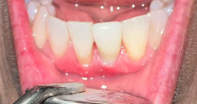 After 4 months healed ceramic implant