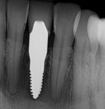 X-Ray image of healed ceramic implant