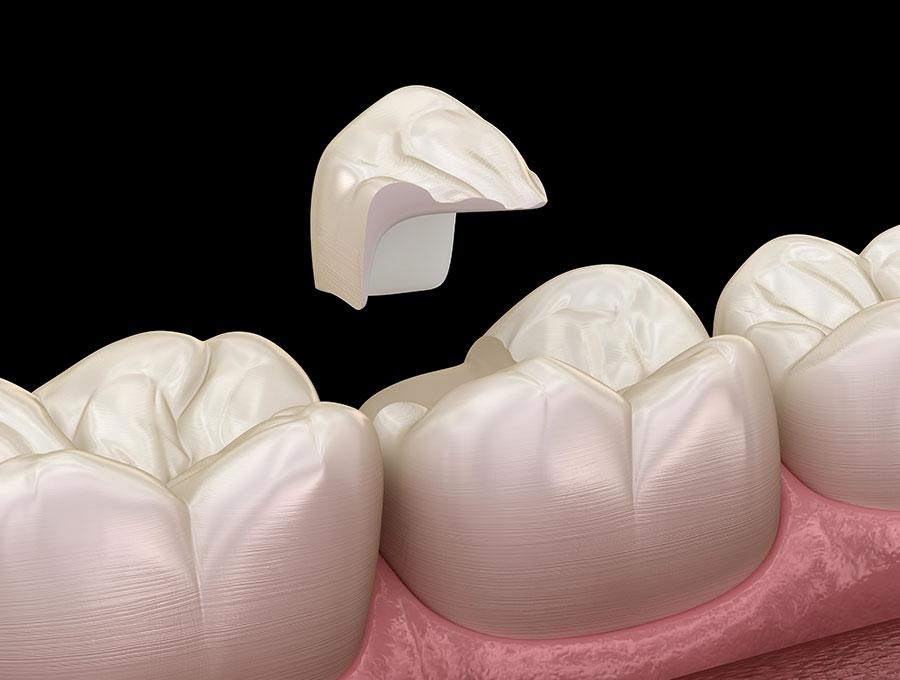 Dental Inlays and Onlays Virginia Biological Dentistry, VA