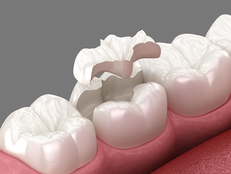 Dental Inlays and Onlays Glen Allen VA