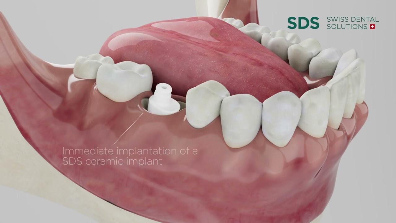 Safe Dental Implants: How They Work And Why They Are Your Best Option For Better Health