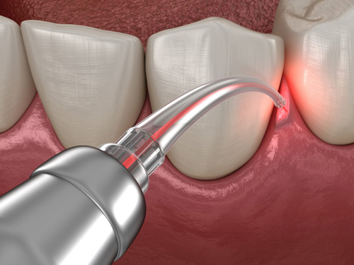 Bio Laser Therapy for Gums