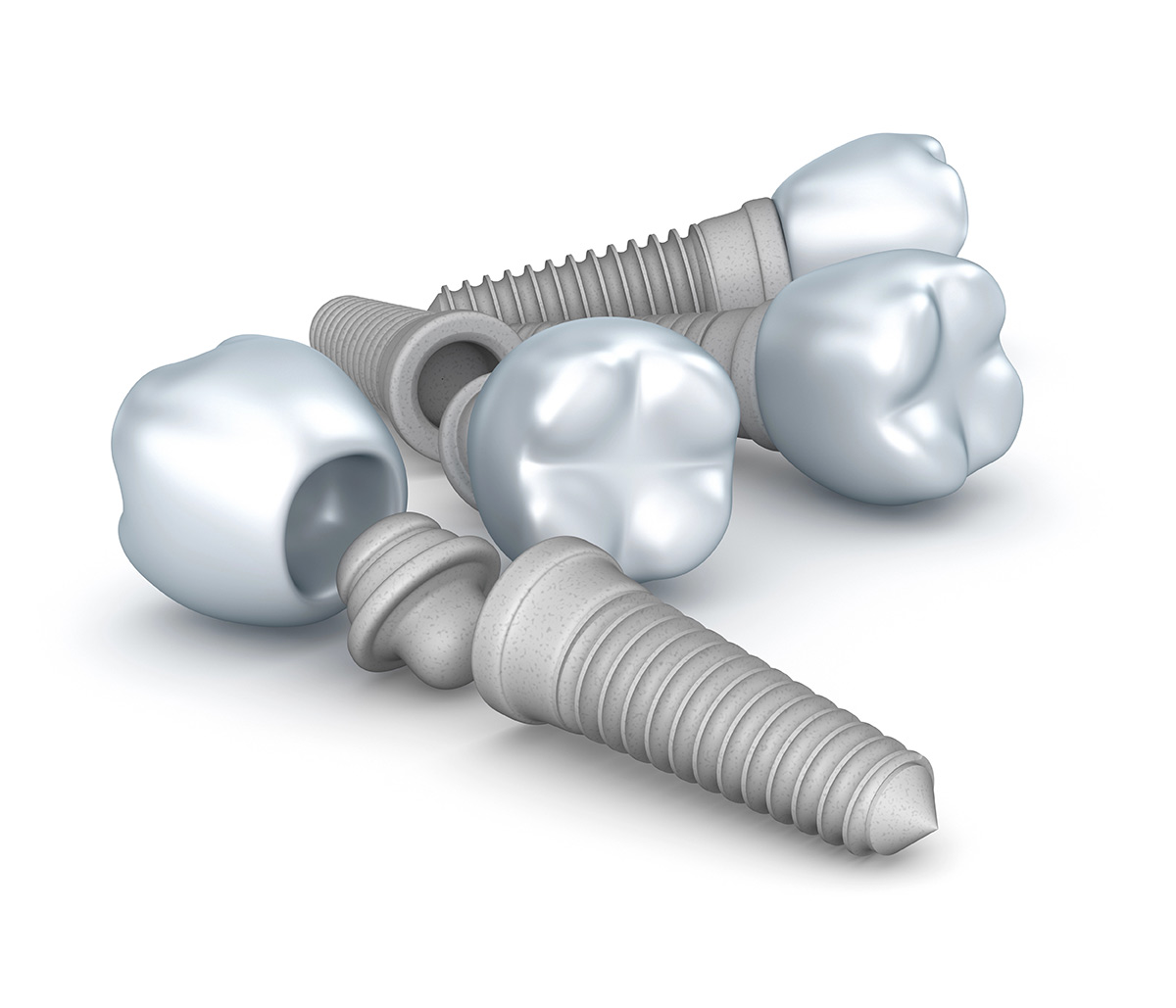 6 Reasons Why Non-Metal Zirconia Implants Are the Ideal Choice for Your Dental Health