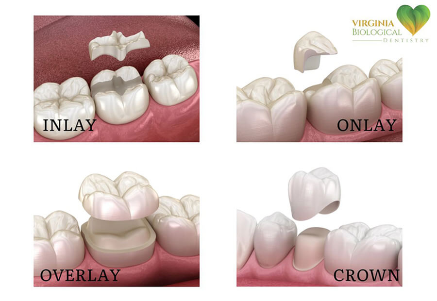 Dental Inlays and Onlays Glen Allen VA, Image-3