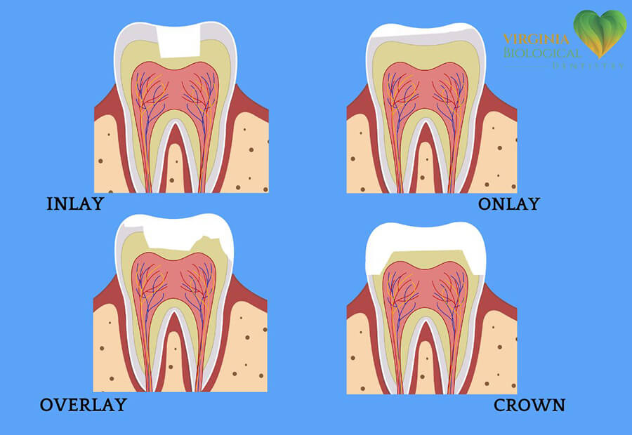 Dental Inlays and Onlays Glen Allen VA, Image-4