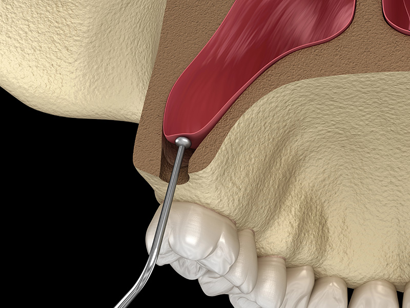 Sinus Augmentation with Dr. Hart in Glen Allen, VA Area