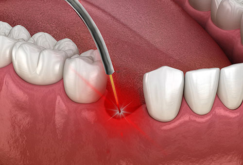 Bio Laser Therapy and PRF in Glen Allen, VA at Virginia Biological Dentistry