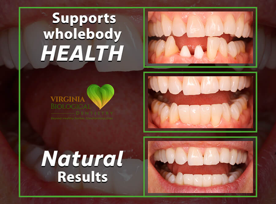 Same-Day Extraction and Ceramic Implant Placement Banner - 1