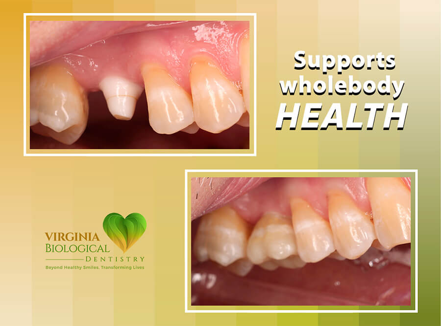 Same-Day Extraction and Ceramic Implant Placement Banner - 2