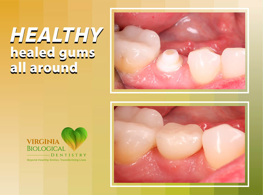 Same-Day Extraction and Ceramic Implant Placement Banner - 3